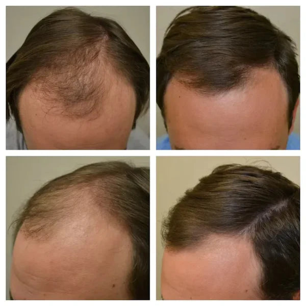 Proskire Hair Growth Serum – Reduces Hair Fall, Boosts Hair Density [Buy 1 Get 1 Free]
