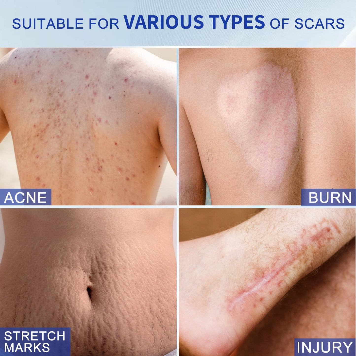 Silicone Scar Cream for Old and New Scars | Buy 1 Get 1 Free