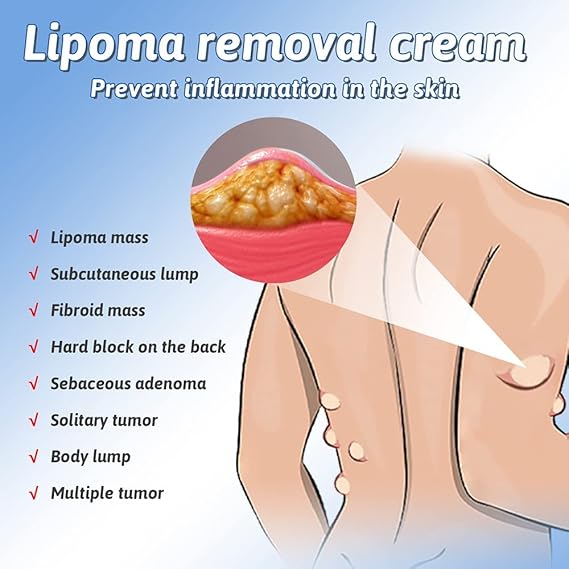 South Moon Lipoma Removal Cream – Herbal Extract