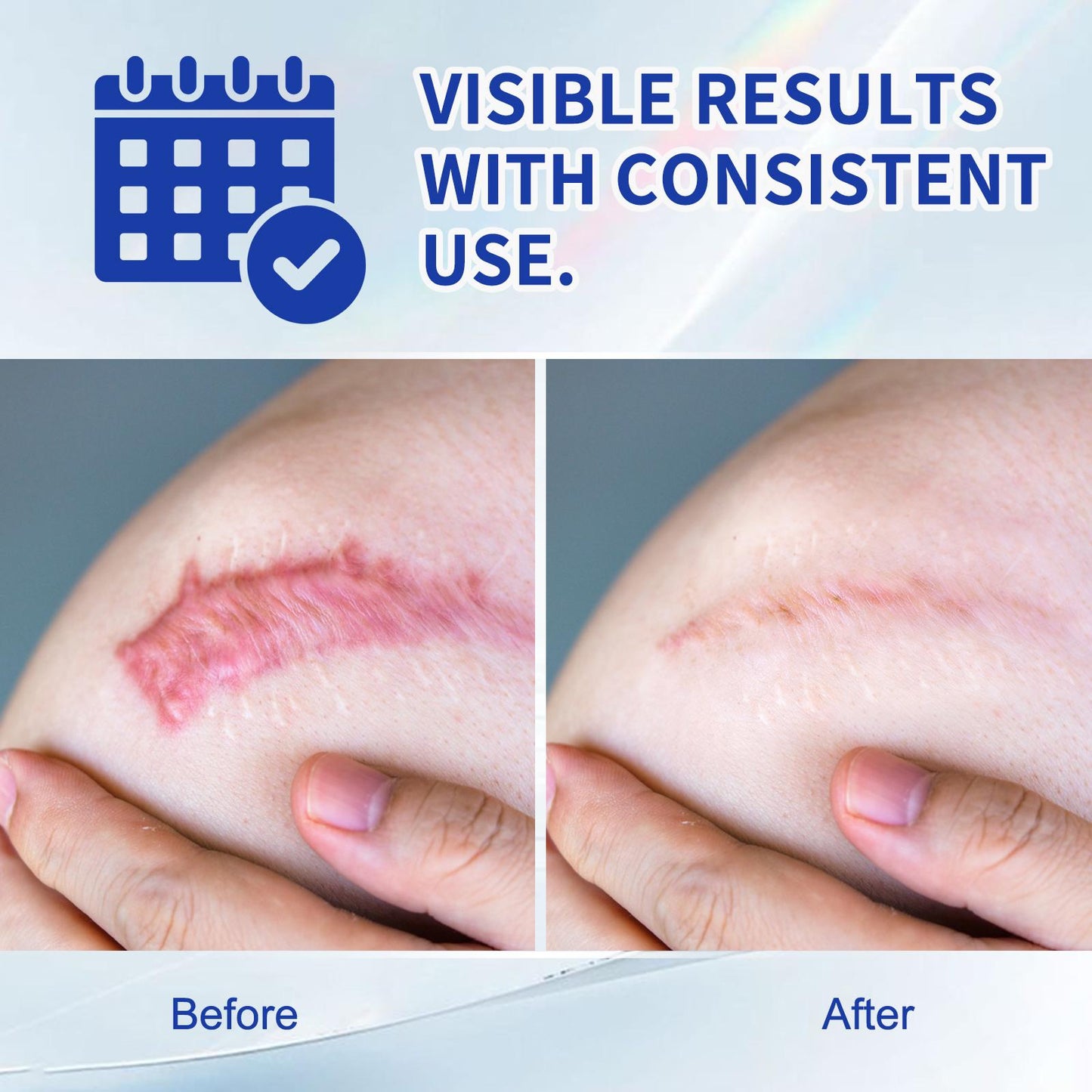 Silicone Scar Cream for Old and New Scars | Buy 1 Get 1 Free