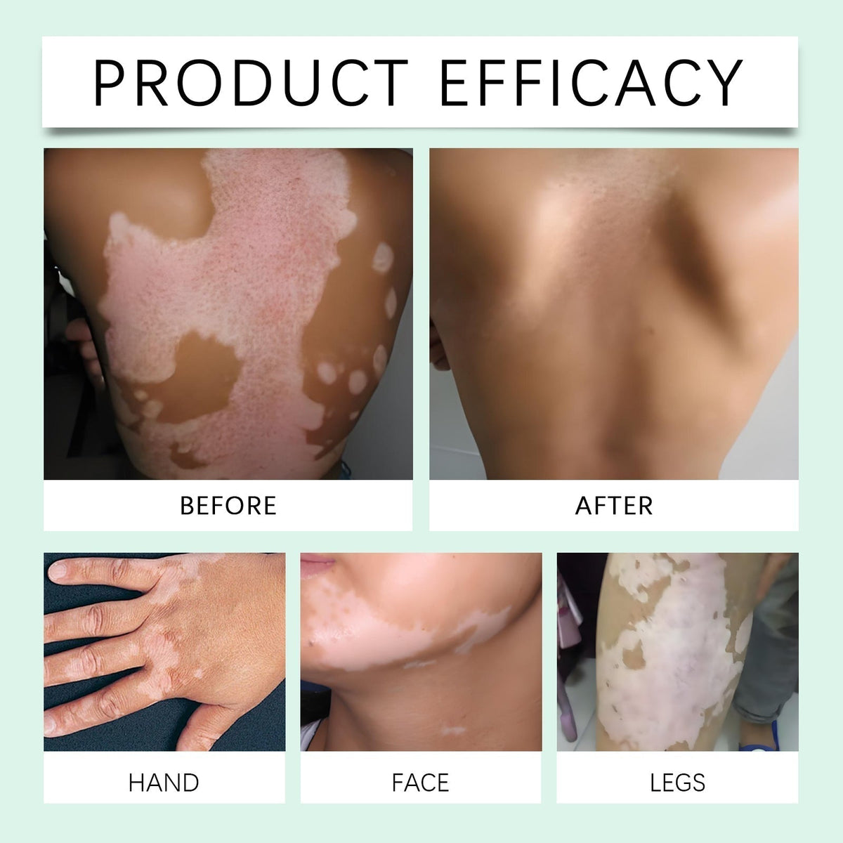 Vitiligo Herbal Aloe Vera & Mint Care Cream [ Buy 1 Get 1 Free ]