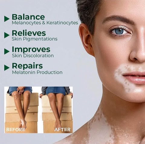 Vitiligo Herbal Aloe Vera & Mint Care Cream [ Buy 1 Get 1 Free ]
