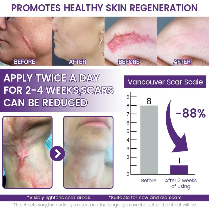 ReGenScar Stem Cell Repair Gel (Visible Scar Improvement in 7 Days) (Buy 1 Get 1 Free)